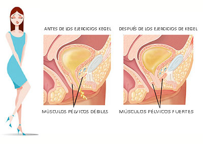 Antes y Después de los Ejercicios de Kegel