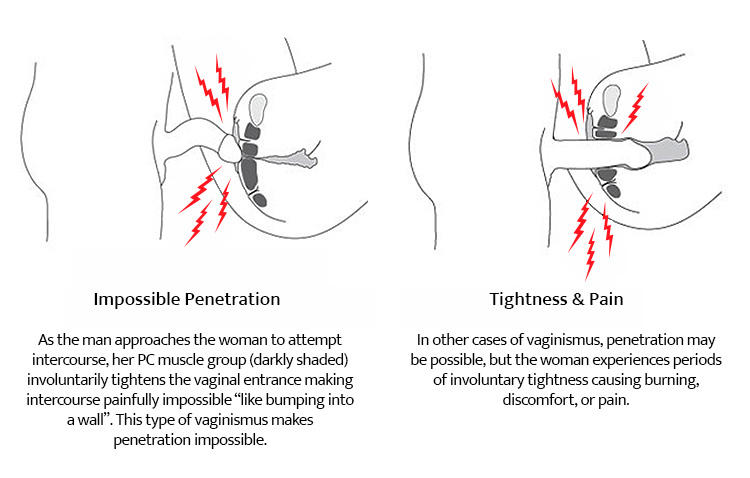 Vaginismus and Dyspareunia