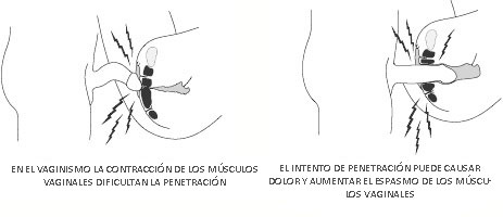 Vaginismo y Dispareunia